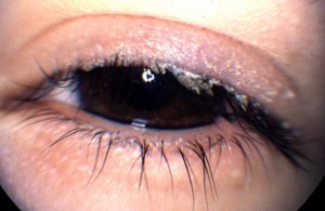 Как лечить демодекоз глаз